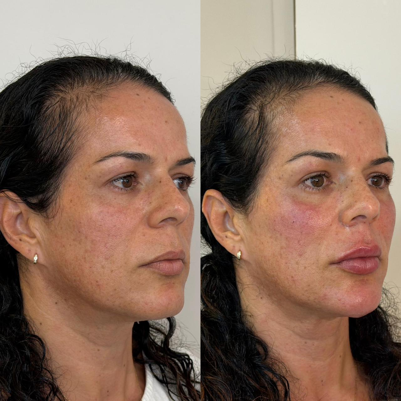 Harmonização facial — resultado 2