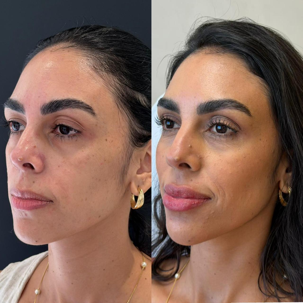 Harmonização facial — resultado 3