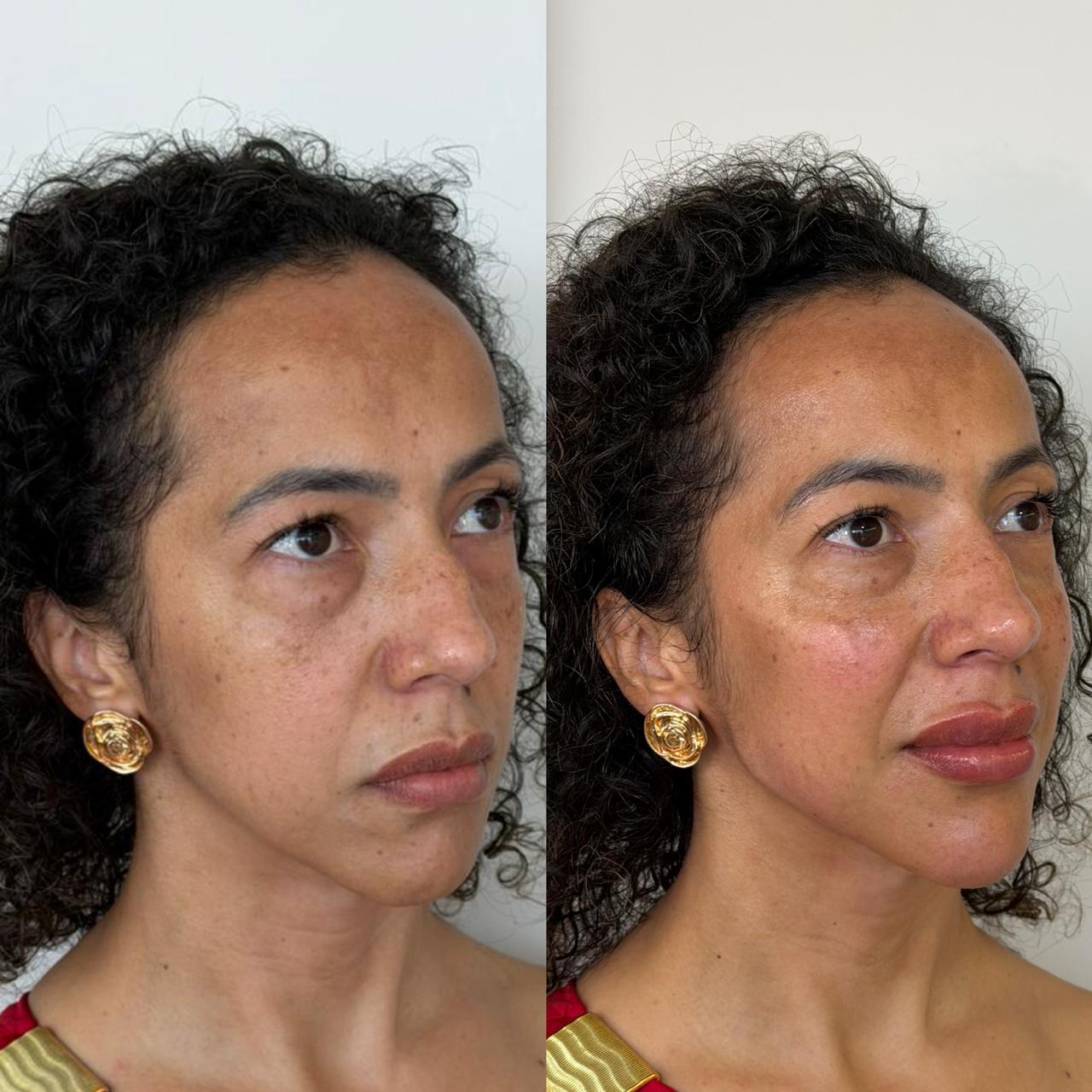 Harmonização facial — resultado 5
