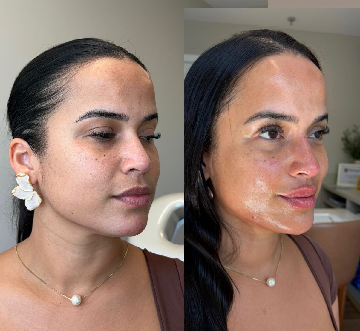 Harmonização facial — resultado 6