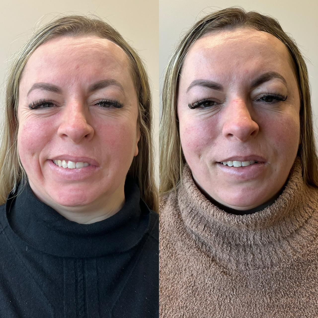 Cinara — antes e depois paralisia facial